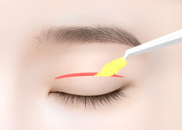 Incisional-Eye-Asymmetry-Correction-step2
