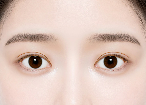 Incisional-Eye-Asymmetry-Correction-step4
