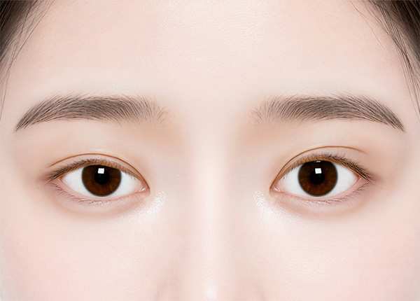 Non-Incisional-Asymmetrical-Eye-Correction-Procedure-step1