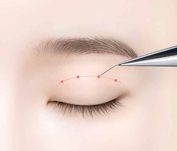 double-eyelid-line-heightening-spe7