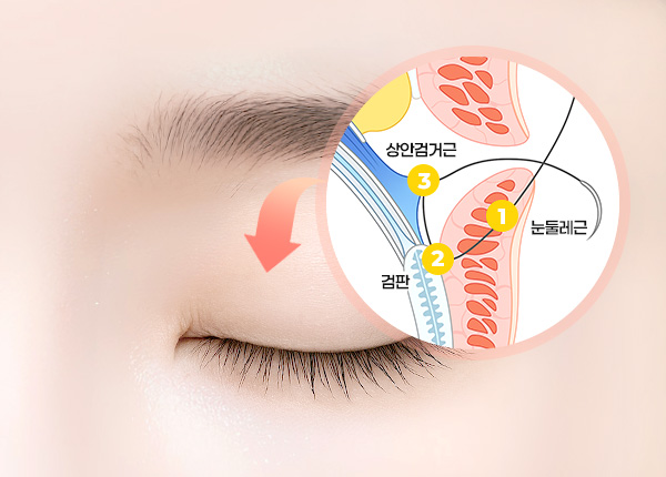 절개쌍꺼풀 수술방법