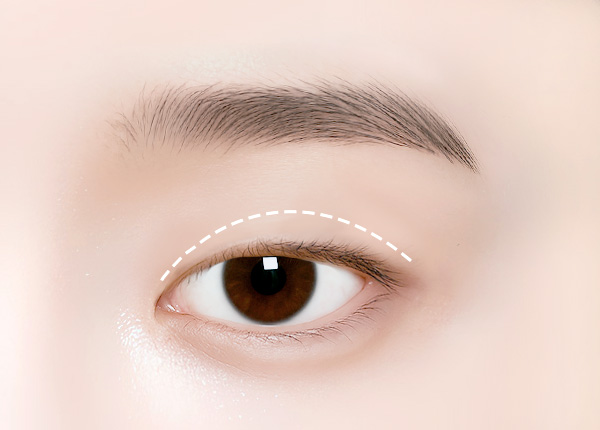자연유착 쌍꺼풀 수술방법1