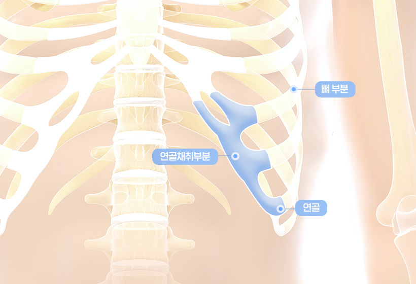 rib-cartilage-rhinoplasty-img