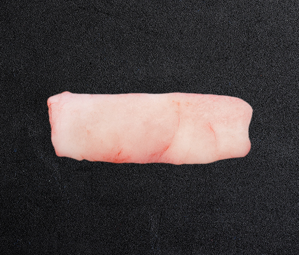 rib-cartilage-rhinoplasty-spe1