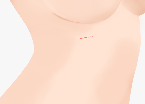 rib-cartilage-rhinoplasty-step1