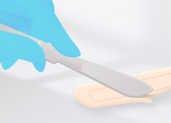 rib-cartilage-rhinoplasty-step3