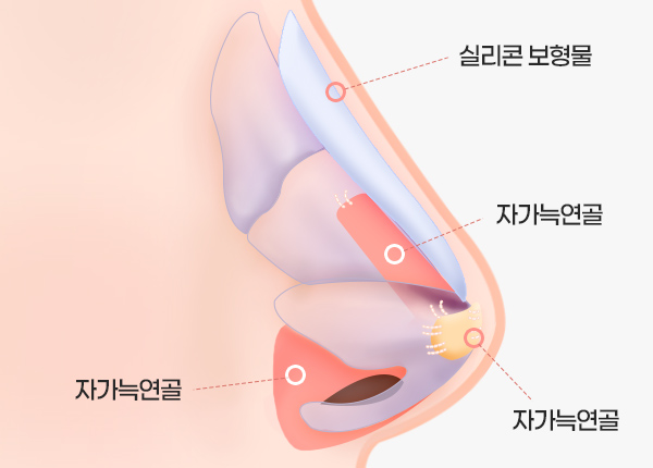 rib-cartilage-rhinoplasty-step5