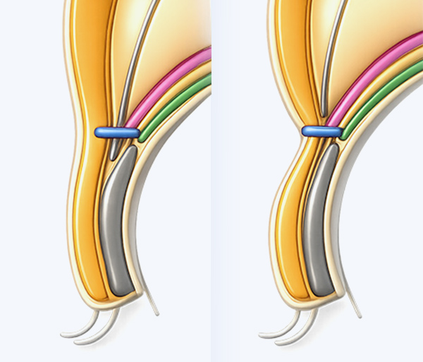 sub_incision_spe3