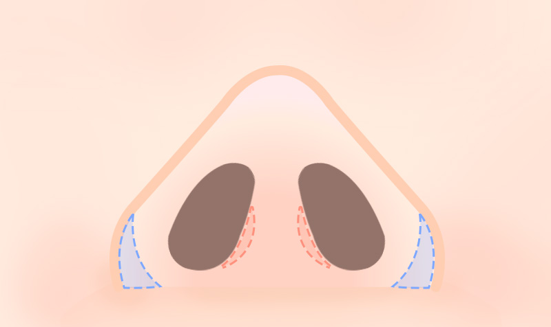 alar-reduction_step4
