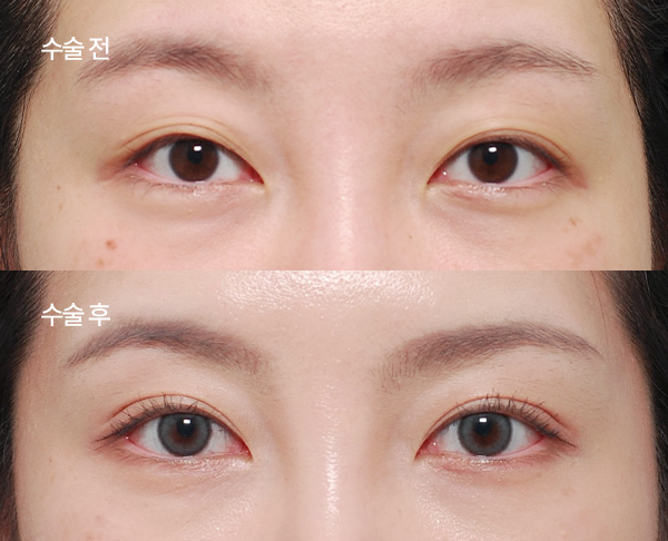 asymmetry-correction_bna2