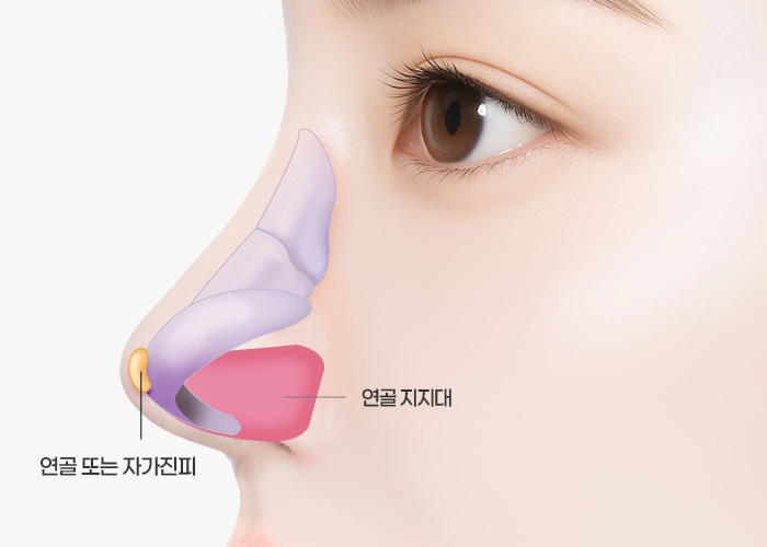 복코 콧볼축소 수술방법
