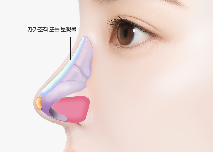 복코 콧볼축소 수술방법