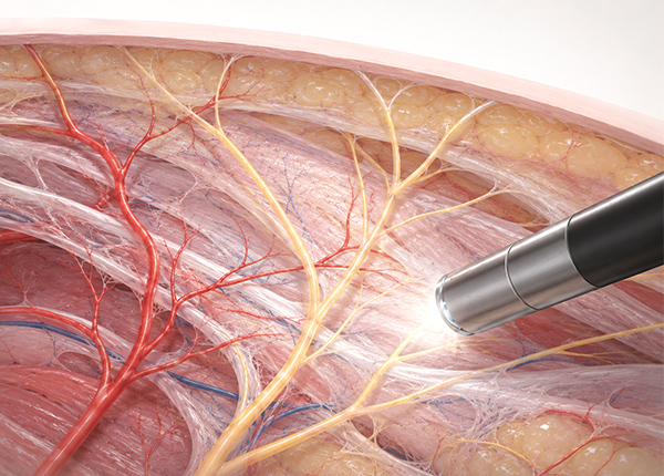 endoscopic-forehead-lift-spe1