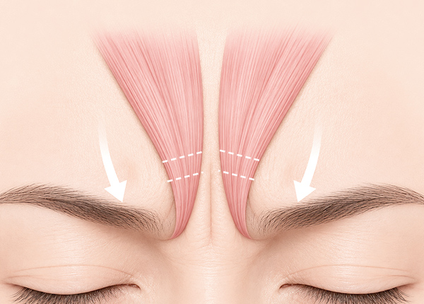 endoscopic-forehead-lift-spe2