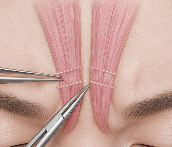 endoscopic-forehead-lift-spe3
