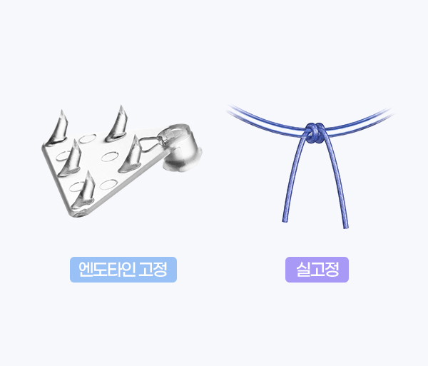endoscopic-forehead-lift-spe5-