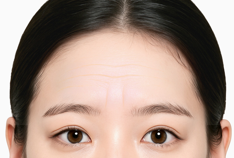 내시경 이마거상술 수술방법