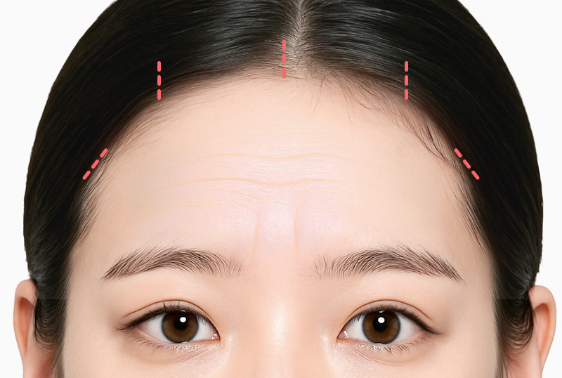 내시경 이마거상술 수술방법