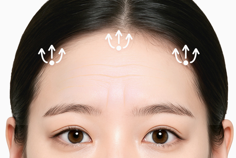 내시경 이마거상술 수술방법