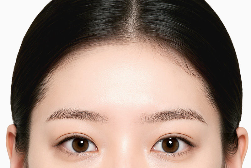 내시경 이마거상술 수술방법