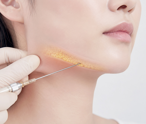 fat-grafting-micro-fat-grafting-spe2