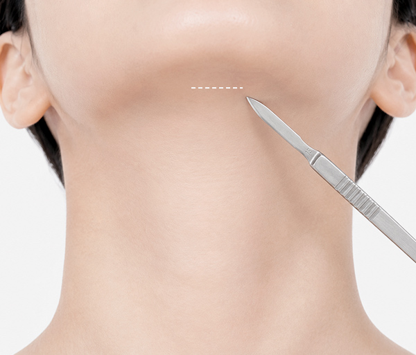 fat-grafting-micro-fat-grafting-spe3