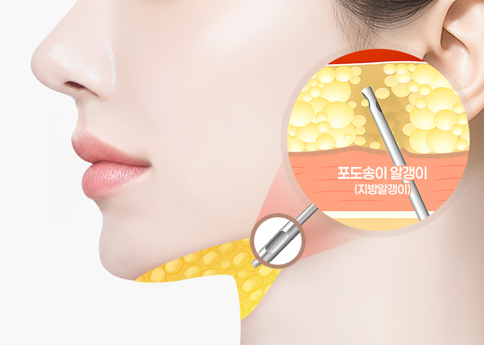턱선·이중턱 지방흡입 수술 방법