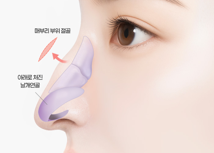 매부리코·긴코 수술방법