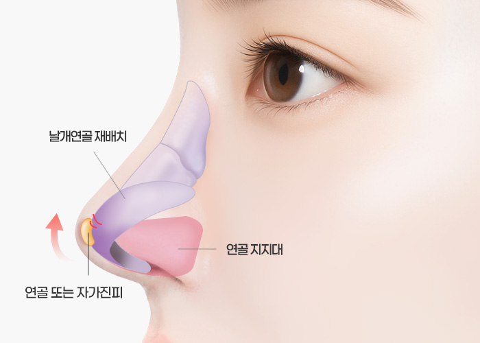 매부리코·긴코 수술방법