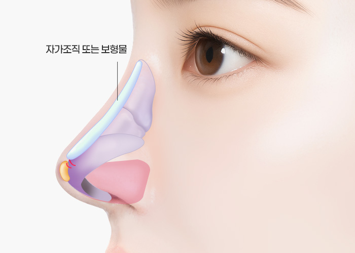 매부리코·긴코 수술방법