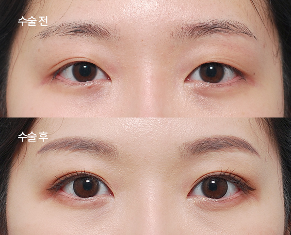 loose-double-eyelid-revision_bna1