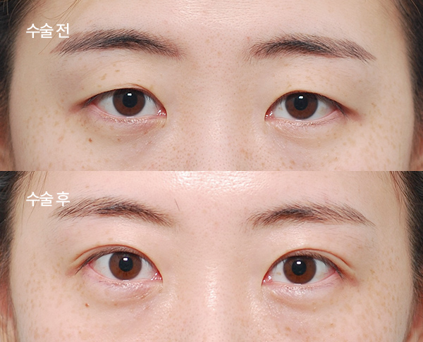loose-double-eyelid-revision_bna3