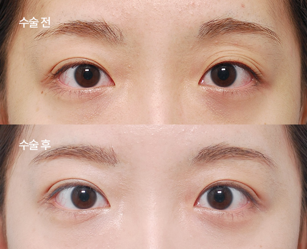 loose-double-eyelid-revision_bna4