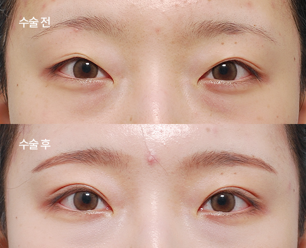 loose-double-eyelid-revision_bna5