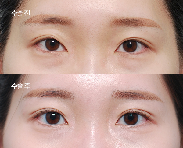 loose-double-eyelid-revision_bna6