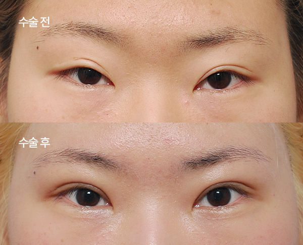 loose-double-eyelid-revision_bna7