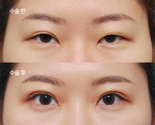 loose-double-eyelid-revision_bna8