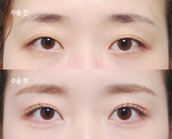 multiple-crease-correction_bna1