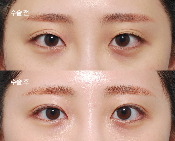 multiple-crease-correction_bna2