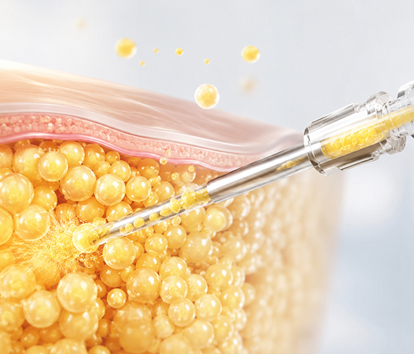 rib-cartilage-rhinoplasty-spe4