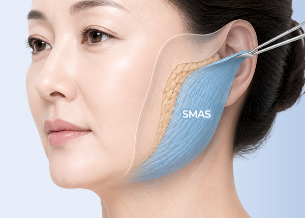smas-facelift-what