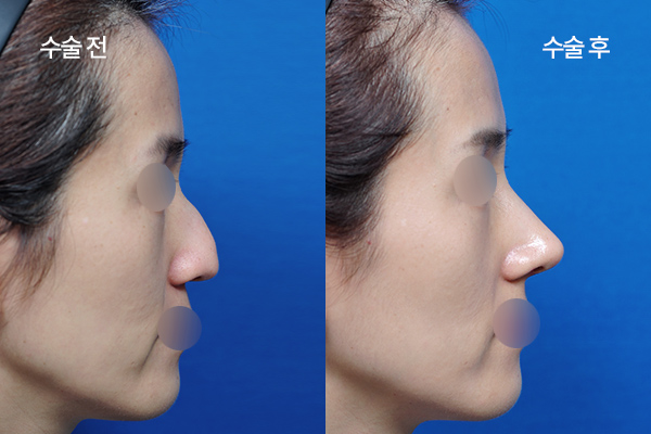 sub-hump-nose-bna2