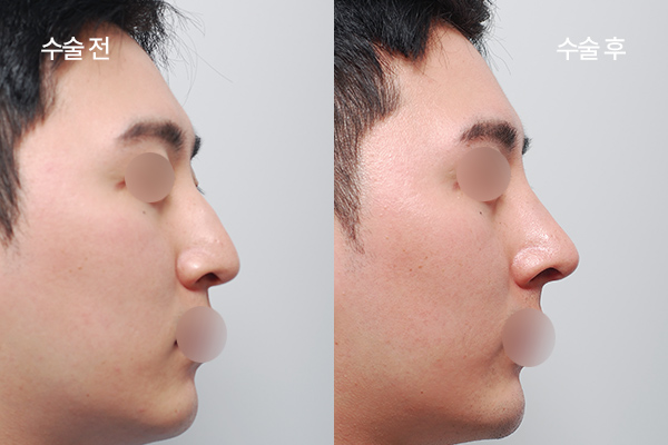 sub-hump-nose-bna3