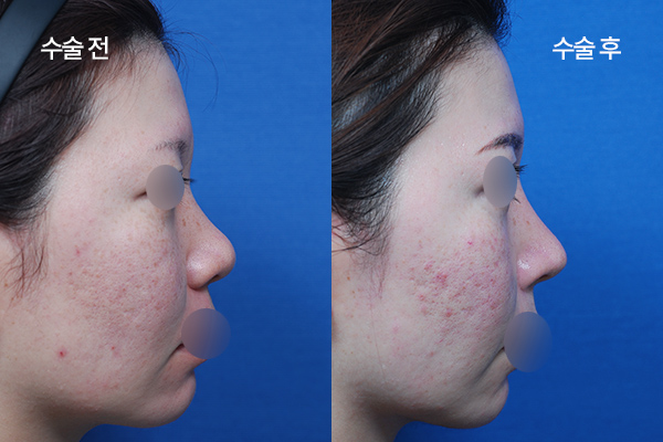 sub-implant-free-bna1
