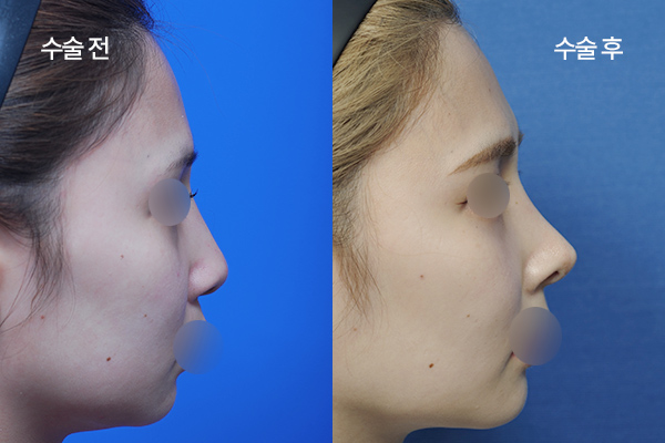 sub-implant-free-bna2