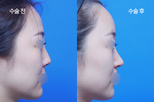 sub-implant-free-bna3