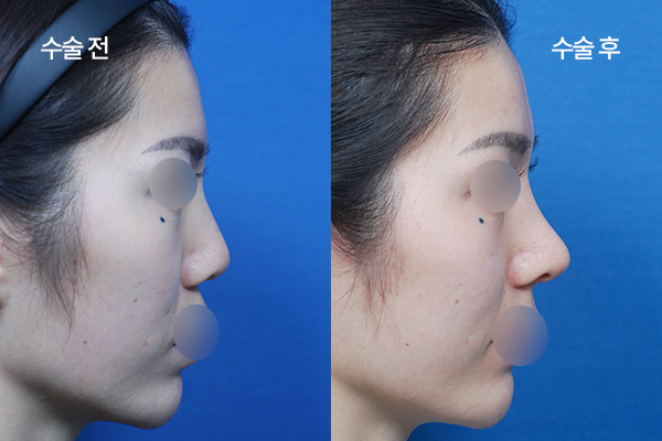 sub-implant-free-bna5