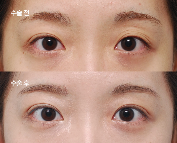 sub-fat grafting bna (1)