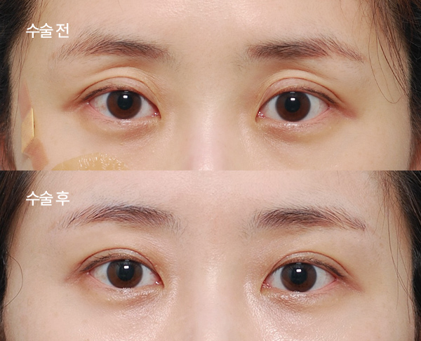 sub-fat grafting bna (2)
