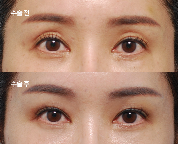 sub-fat grafting bna (3)